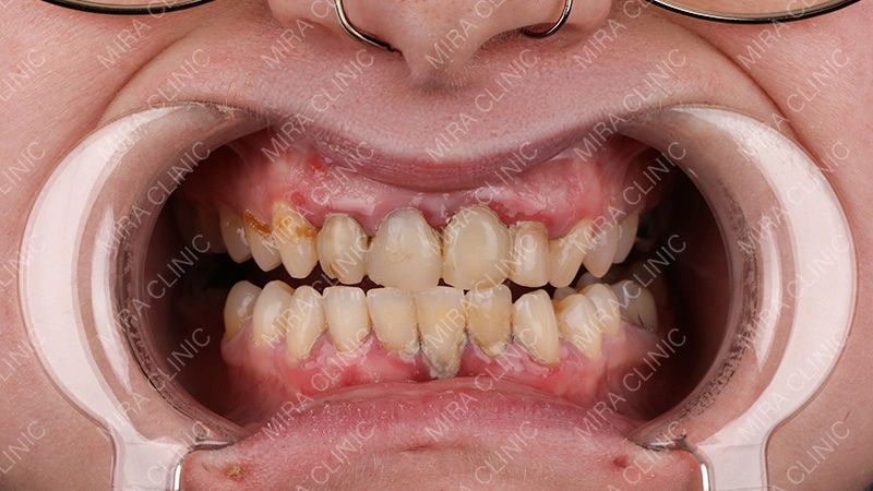 Dental Insecurity Before the Hollywood Smile